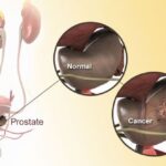 पिसाबको समस्या कतै प्रोस्टेट क्यान्सरको लक्षण त होइन ?