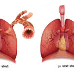 दमको समस्या घटाउन खानुस् यस्ता खानेकुरा