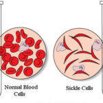 के हो सिकलसेल एनिमिया ?